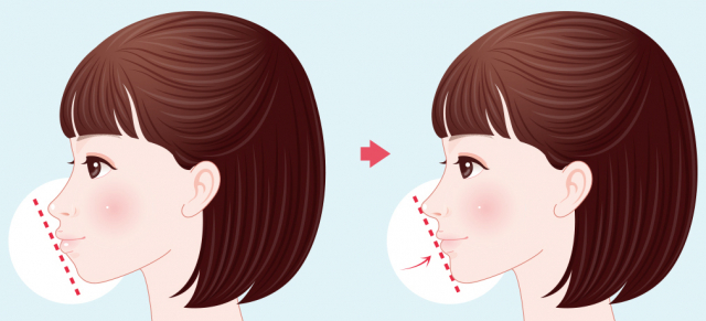 뮤잉운동을 만든 마이크 뮤 박사는 올바른 혀 위치로 얼굴형을 개선할 수 있다고 주장한다.