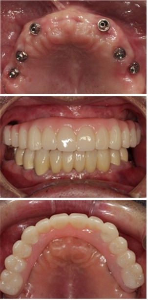 사진은 디지털 전체 임플란트 수술법으로 치료한 70대 남성의 치아. 노바치과 제공