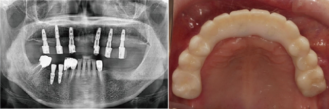 디지털 전체 임플란트 수술법으로 치료한 80대 환자의 치아. 보철물이 고정돼 있고 입천장을 덮지 않는다. 노바치과 제공