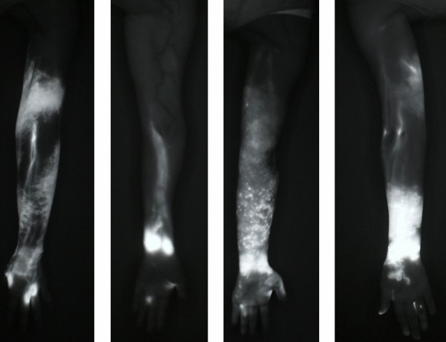 림포스코프 ICG로 림프부종 환자의 팔을 촬영한 이미지. 형광염료가 림프관 위치와 림프액이 쌓인 위치를 보여준다. 부산대병원 제공