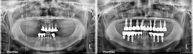 아래위 어금니 부위에 부분 틀니를 사용하던 70대 환자의 무절개 내비게이션 임플란트 수술 전후 엑스레이 사진. 노바치과 제공