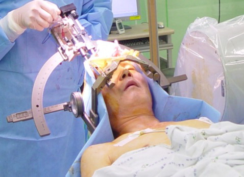 뇌 속에 미세전극을 삽입하는 ‘심부뇌자극술’ 수술 모습. 해운대백병원 제공