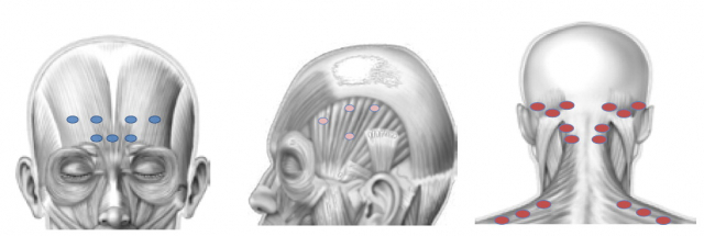 두통 환자의 보톡스 주사 부위