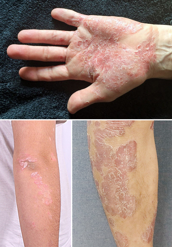 건선은 연고제, 먹는약, 광선치료 등 자신에게 맞는 치료법으로 꾸준히 관리해야 한다. 사진은 손, 팔꿈치, 발 등에 생긴 건선. 부산백병원 제공