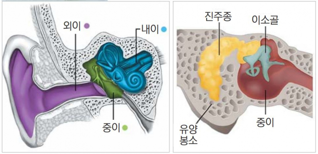 귀의 구조도와 중이에 생긴 진주종(진주 모양의 종양).