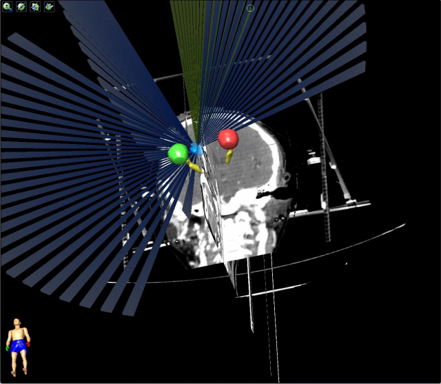 뇌종양환자에게 고선량의 방사선을 쏘는 정위적 방사선 치료 장면.