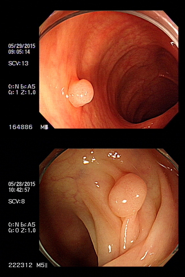 서구식 식습관이 대장암 발병 위험을 키우고 있다. 내시경으로 대장 내부를 촬영한 사진에 선종성 용종이 보인다.