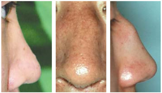 낮은 코, 휜 코, 매부리코(왼쪽부터)는 CT를 찍어보면 대부분 코뼈 골절이 확인된다. 정승문성형외과 제공