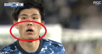 아랫니가 빠진 도미야스. 온라인 커뮤니티 캡처