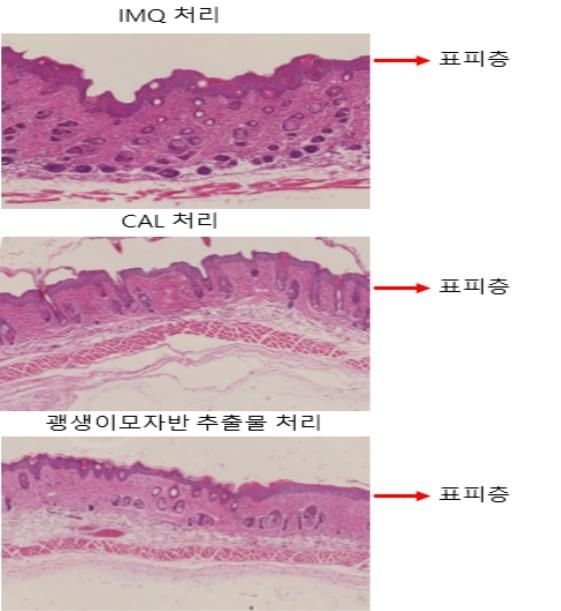 괭생이모자반 추출물을 투여한 실험쥐의 피부조직 변화 . 첫 번째 사진은 위에서부터 이미퀴모드(IMQ) 약제로 건선을 유도한 실험쥐의 피부의 각화현상이다. 두 번째는 기존 건선 치료제를 처리한 피부로 표피층이 얇아졌다. 괭생이모자반 추출물을 처리(세 번째)했을때도 표피의 각화층이 얇아져 건선 치료 효과가 나타난 것을 확인했다. 해수부 제공