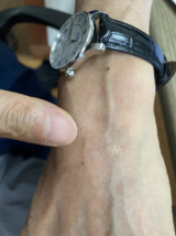 최 위원 손등의 흉터.