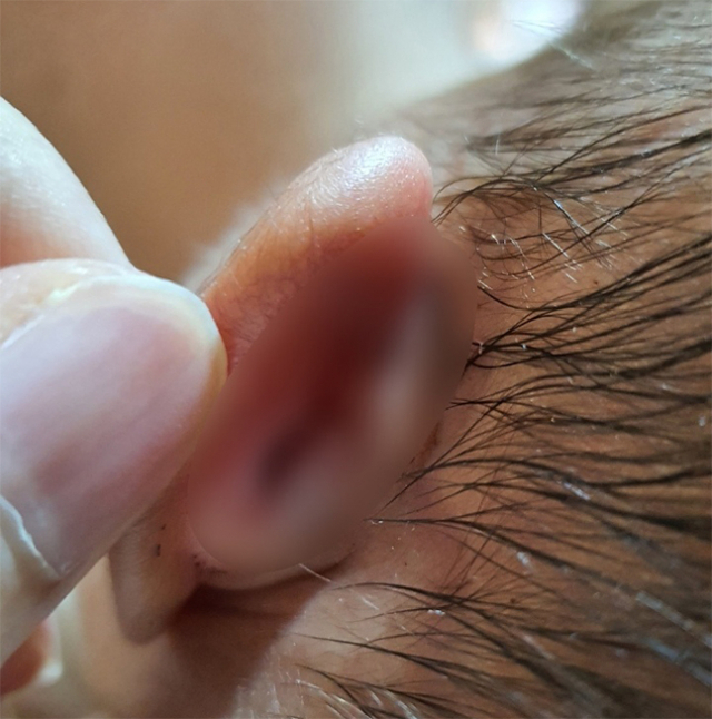 2021년 2월 부산 사하구의 한 산후조리원에서 생후 19일 된 신생아 귀를 잡고 비트는 등 상해를 입힌 혐의를 받는 간호조무사 A 씨에게 피해를 당한 아이의 모습. 아이 엄마 B 씨 제공