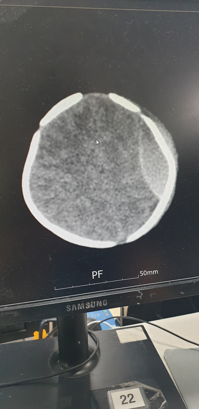 같은 산후조리원에서 지난해 11월 생후 13일 신생아가 처치대에서 떨어져 머리를 다치는 사고도 발생했다. 사진은 낙상 피해 아기 머리 CT 사진. 낙상 피해 부모 측 제공