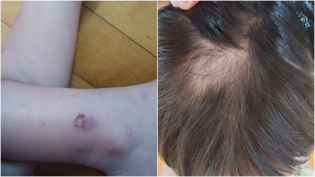 자녀의 몸에 멍자국과 머리카락이 뽑힌 자국을 본 학부모가 경찰에 신고하면서 해당 어린이집에 대한 조사가 시작됐다. 피해 아동 학부모 제공