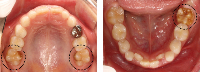 앞니와 어금니 쪽이 황색이나 갈색으로 변색되거나 치아 일부가 떨어져 나가는 증상이 치아 저광화증이다(점선 부분). 부산대치과병원 제공