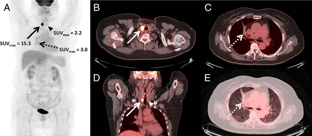 18F-FDG PET/CT 결과. 동남권원자력의학원 제공