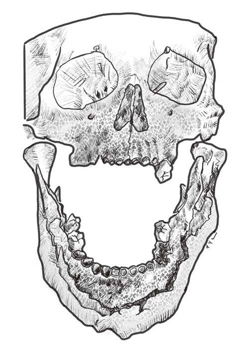 성냥공장에서 일하던 노동자들은 백린이라는 물질 때문에 턱뼈가 녹아내리고 고름이 잇몸을 뚫고 흘러나와 고통당했다. 세종서적 제공