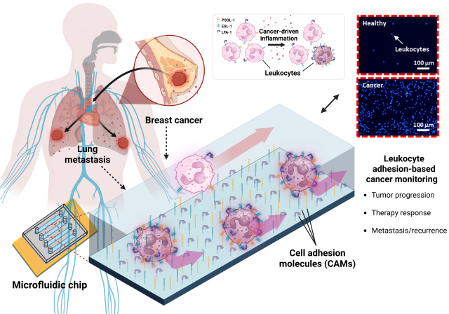 그림. 백혈구 부착(leukocyte adhesion) 기반 실시간 암 모니터링 바이오칩 개념도. 암 조직이 자라면서 생긴 염증 반응은 혈액 속 백혈구의 성질을 바꿔, 백혈구가 혈관 내벽에 더 잘 달라붙게 만든다. 연구팀은 혈관 내벽 환경을 모사한 미세유체 칩을 제작하고, 그 안에 혈액을 흘려보내 관 벽에 부착되는 백혈구의 수를 측정했다. 칩 표면에는 염증 상황에서 혈관 내피에 나타나는 세포부착분자들이 배치돼 있어, 실제 혈관과 유사한 조건을 만들었다. 이 방식으로 백혈구 부착 정도를 정량적으로 분석하면 암의 진행 상황은 물론, 항암 치료에 대한 반응이나 수술 후 전이·재발 여부를 모니터링할 수 있다. UNIST 제공