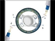 ‘카나브라바’ 무봉합 공막고정술 개념도. 더참안과의원 제공